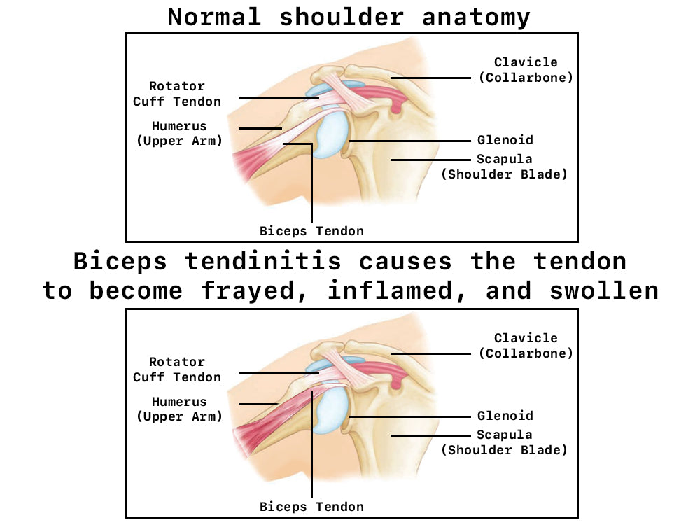 Descrizione della tendinite del bicipite