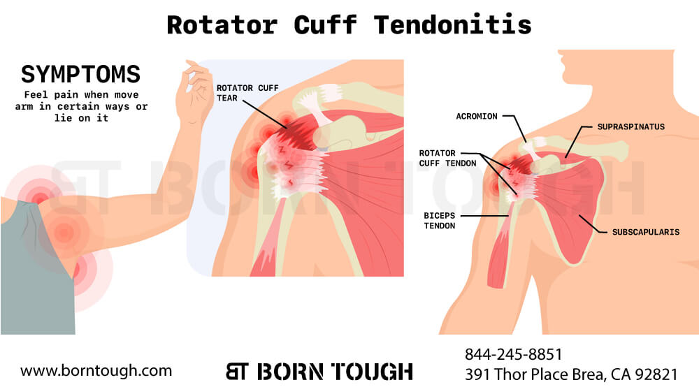 Tendinite della cuffia dei rotatori